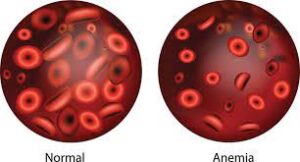 Anemia – Causes, Types and Treatment